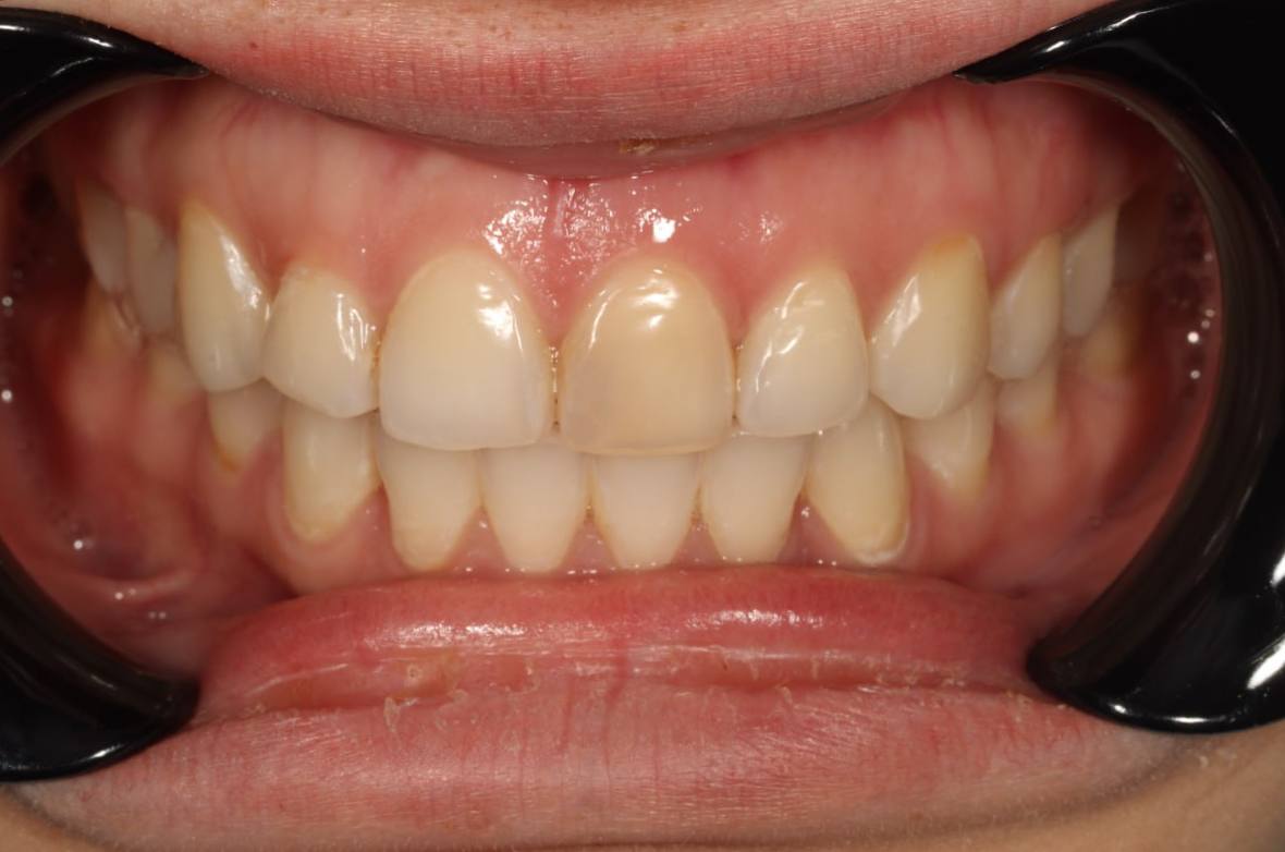 Отбеливание