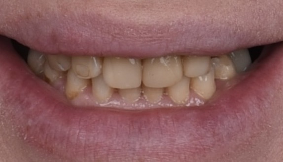 Отбеливание