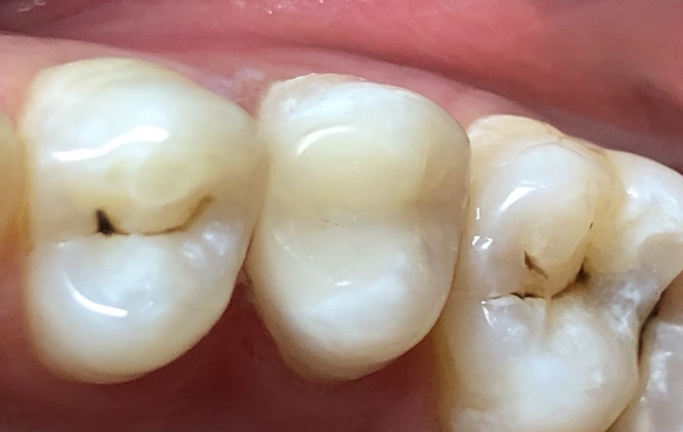 Восстановление со стекловолокном