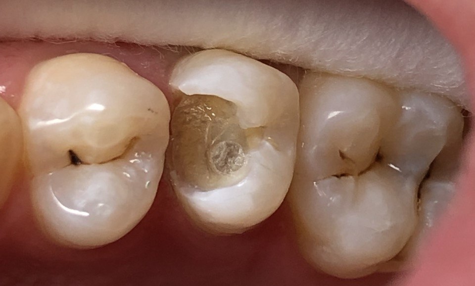 Восстановление со стекловолокном