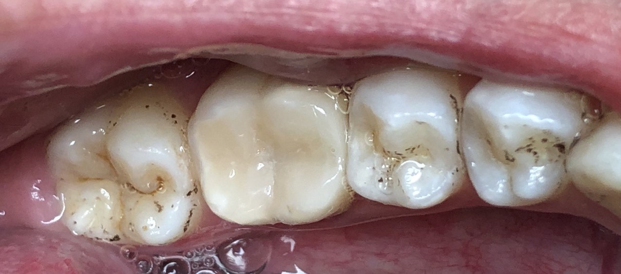 Восстановление со стекловолокном